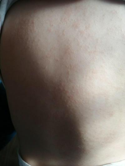 Dětské nemoci | Vyrážka 8 mesicni kojenec