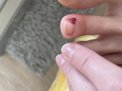 Zdravotní potíže dospělých | Je to zarostly nehet?