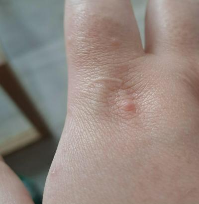 Zdravotní potíže dospělých | Pupínky na ruce