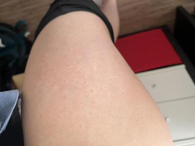 Alergie a ekzémy | Alergicka reakce či co?