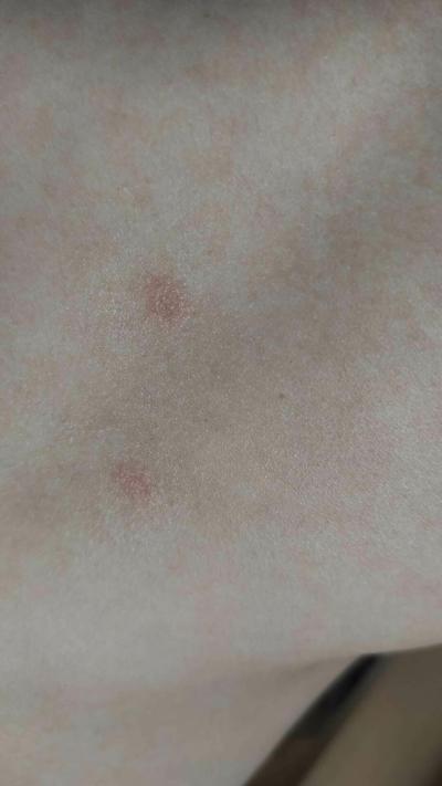 Alergie a ekzémy | Červné flíčky na břiše