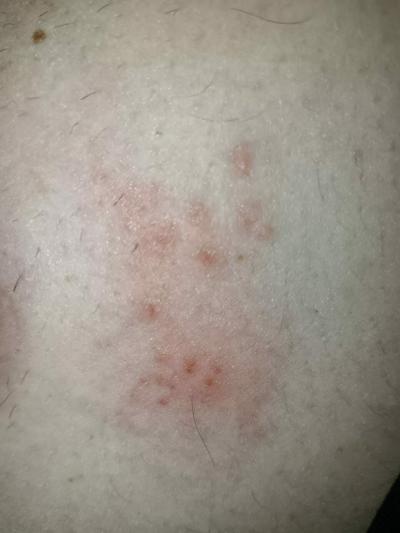 Alergie a ekzémy | Co je to prosím za stipanec?