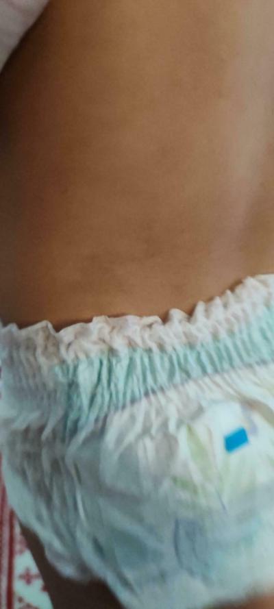 Dětské nemoci | Neurofibromatóza u 18m dítěte