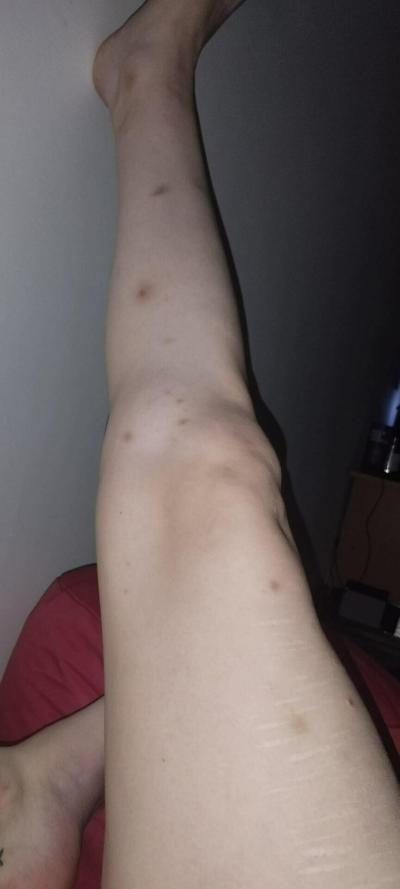 Zdravotní potíže dospělých | Modřiny na nohou bez příčiny