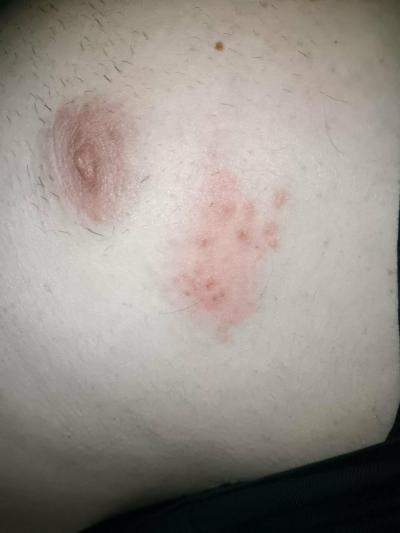 Alergie a ekzémy | Co je to prosím za stipanec?