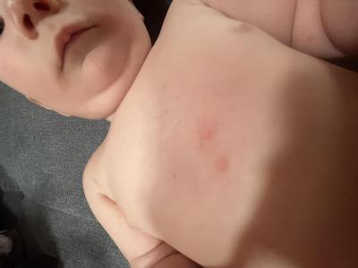 Alergie a ekzémy | Mnoho červených pupínků 7M