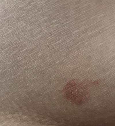 Vše možné | Flek nad zadkem
