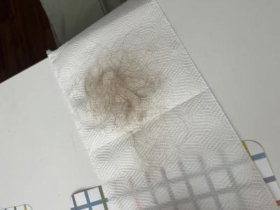 Zdravotní potíže dospělých | Nadměrné padání vlasů