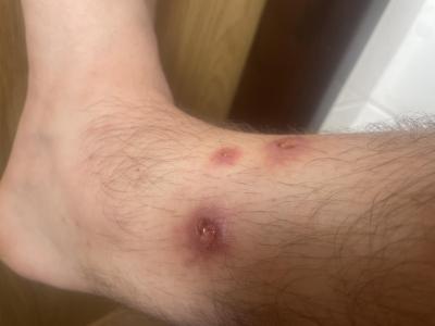 Dětské nemoci | Impetigo nemizí