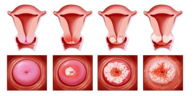Gynekologické potíže | Může nepravidelná menstruace znamenat vážný zdr. problém?