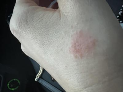 Alergie a ekzémy | Ekzém nebo vyrážky u dospělého