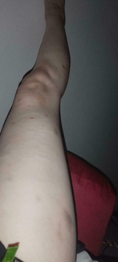 Zdravotní potíže dospělých | Modřiny na nohou bez příčiny