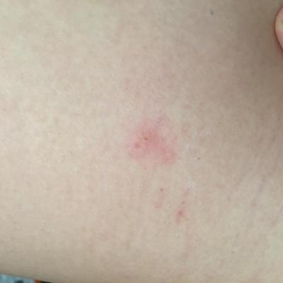 Alergie a ekzémy | Štípance od mravence?
