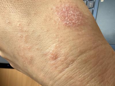 Alergie a ekzémy | Ekzém nebo vyrážky u dospělého