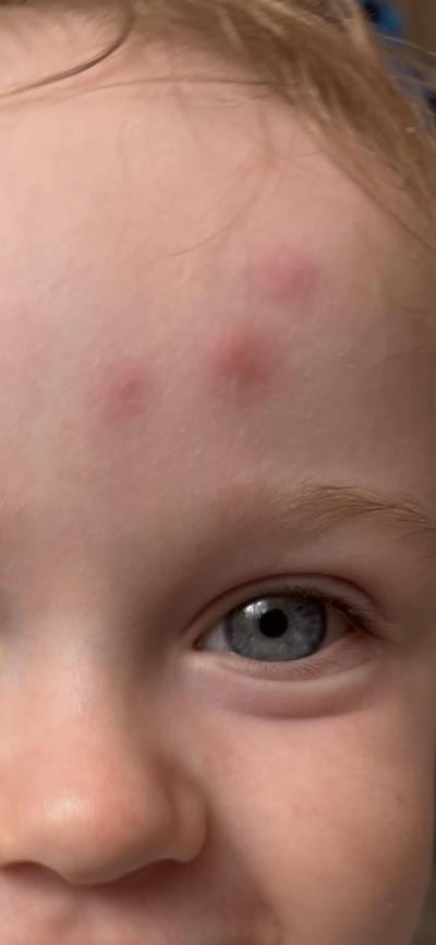 Batole (12 až 36 měsíců) | Co to může být za flíčky?