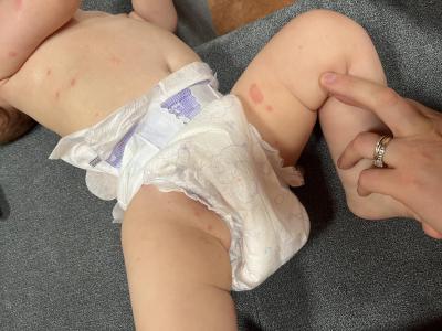 Alergie a ekzémy | Mnoho červených pupínků 7M