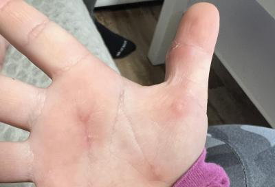 Dětské nemoci | Pupeny na dlaních