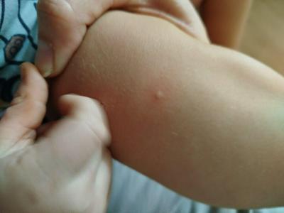 Alergie a ekzémy | Mizející vyrážka u miminka