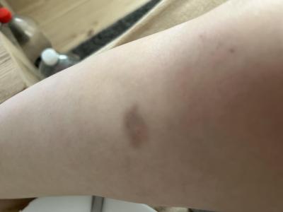 Antikoncepce | Modrina, nemoc a antikoncepce