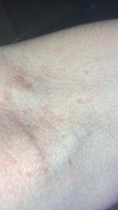 Alergie a ekzémy | Zajímavá vyrážka na těle