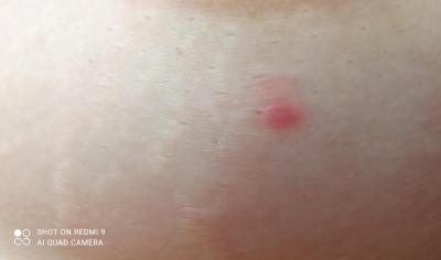 Zdravotní potíže dospělých | Červený pupínek na prsu