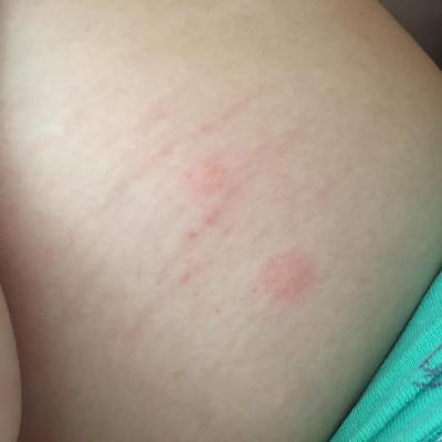 Alergie a ekzémy | Štípance od mravence?