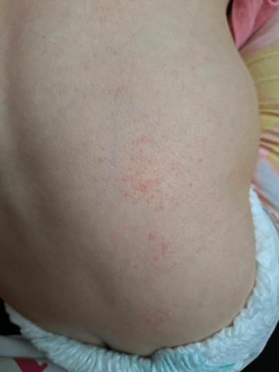 Alergie a ekzémy | Pupínky - vyrážka u batolete