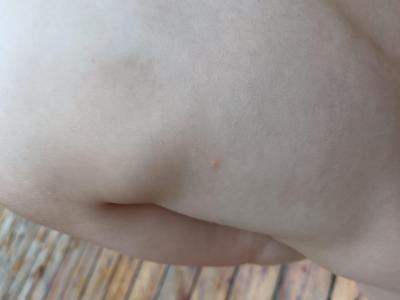 Dětské nemoci | Neštovice nebo???