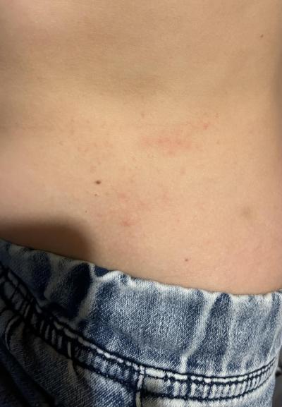 Alergie a ekzémy | Jedná se o svrab?
