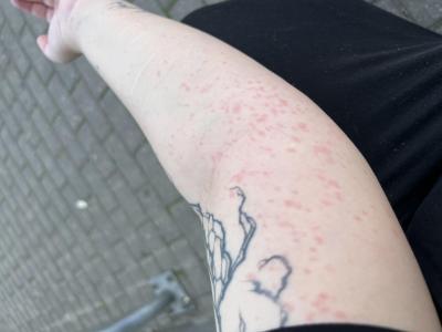 Zdravotní potíže dospělých | Vyrážka na těle (termoregulace)