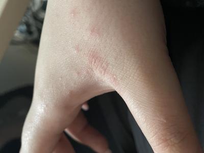 Alergie a ekzémy | Kožní vyrážka. Prosím nevíte?