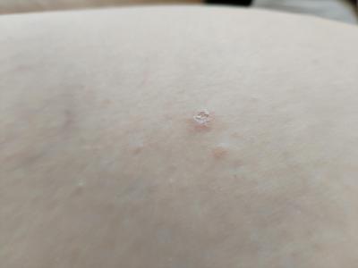 Alergie a ekzémy | Suché fleky na těle