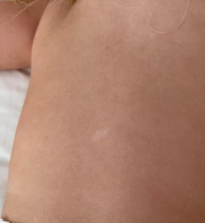 Dětské nemoci | Bilý flek na kůži batolete