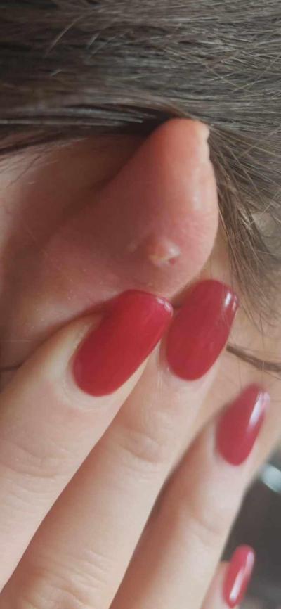 Zdravotní potíže dospělých | Piercing Helix boule