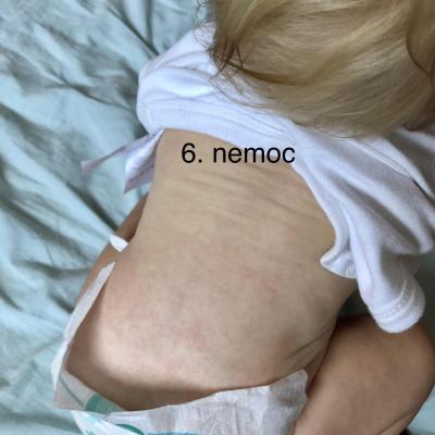 Dětské nemoci | Je to šestá nemoc? Vyrážka a teploty
