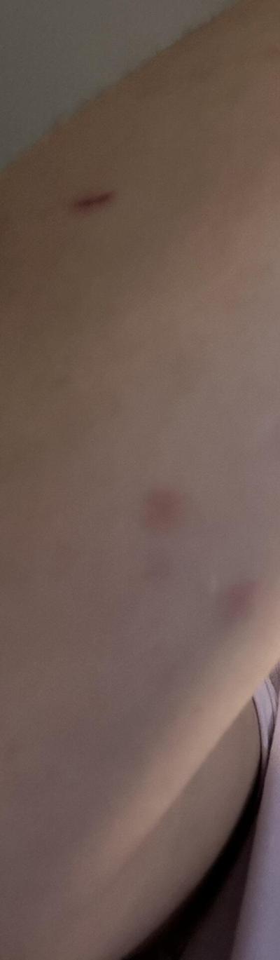 Alergie a ekzémy | Skvrnky na kůži.