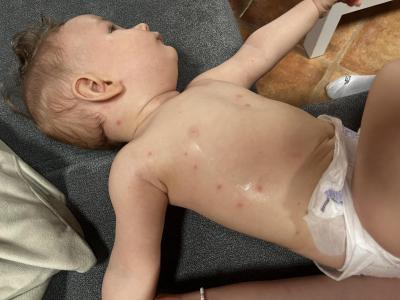 Alergie a ekzémy | Mnoho červených pupínků 7M
