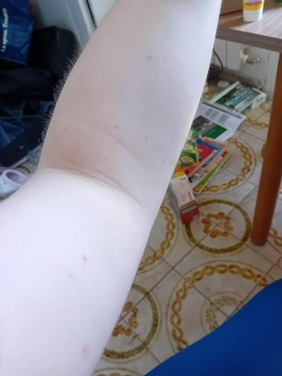 Zdravotní potíže dospělých | Štěnice, nebo blecha?