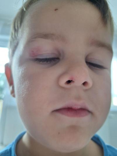 Impetigo na oku a nose už skoro zahojené