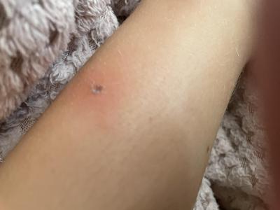 Dětské nemoci | Impetigo nebo štípanec