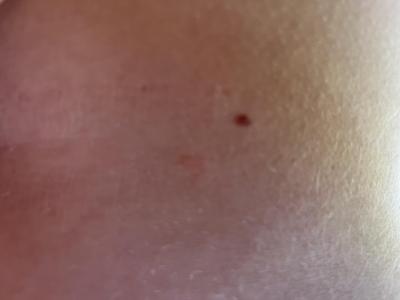 Alergie a ekzémy | Fleky na hrudi