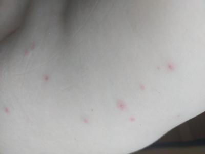 Zdravotní potíže dospělých | Stipnuti/alergie? Co myslite?