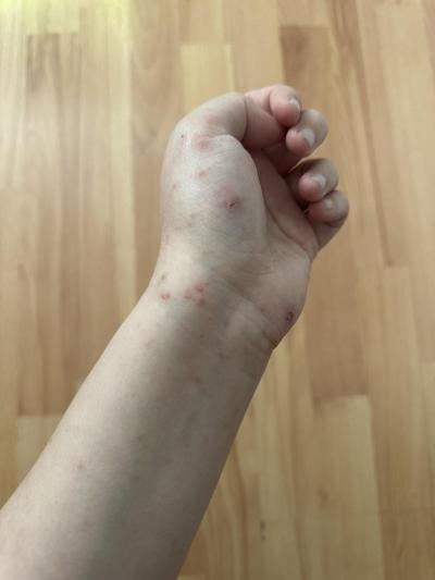 Alergie a ekzémy | Svrab, exem nebo vyrážka?