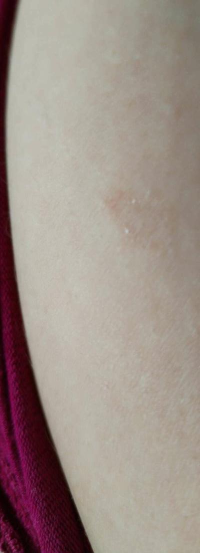 Alergie a ekzémy | Suché fleky na těle