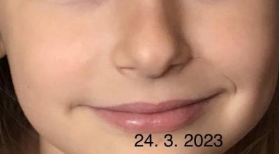 Dětské nemoci | Žilky v ohybu nosu u dítěte