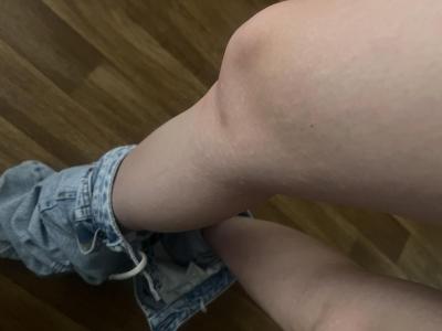 Alergie a ekzémy | Alergicka reakce či co?
