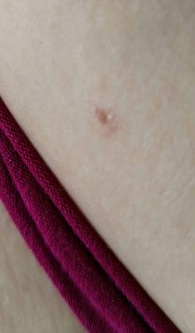 Alergie a ekzémy | Suché fleky na těle