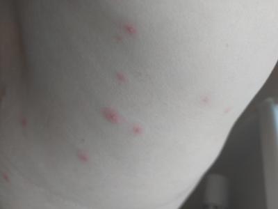 Zdravotní potíže dospělých | Stipnuti/alergie? Co myslite?