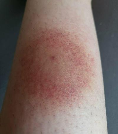 Alergie a ekzémy | Borelióza nebo alergická reakce?