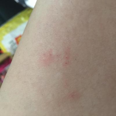 Alergie a ekzémy | Štípance od mravence?